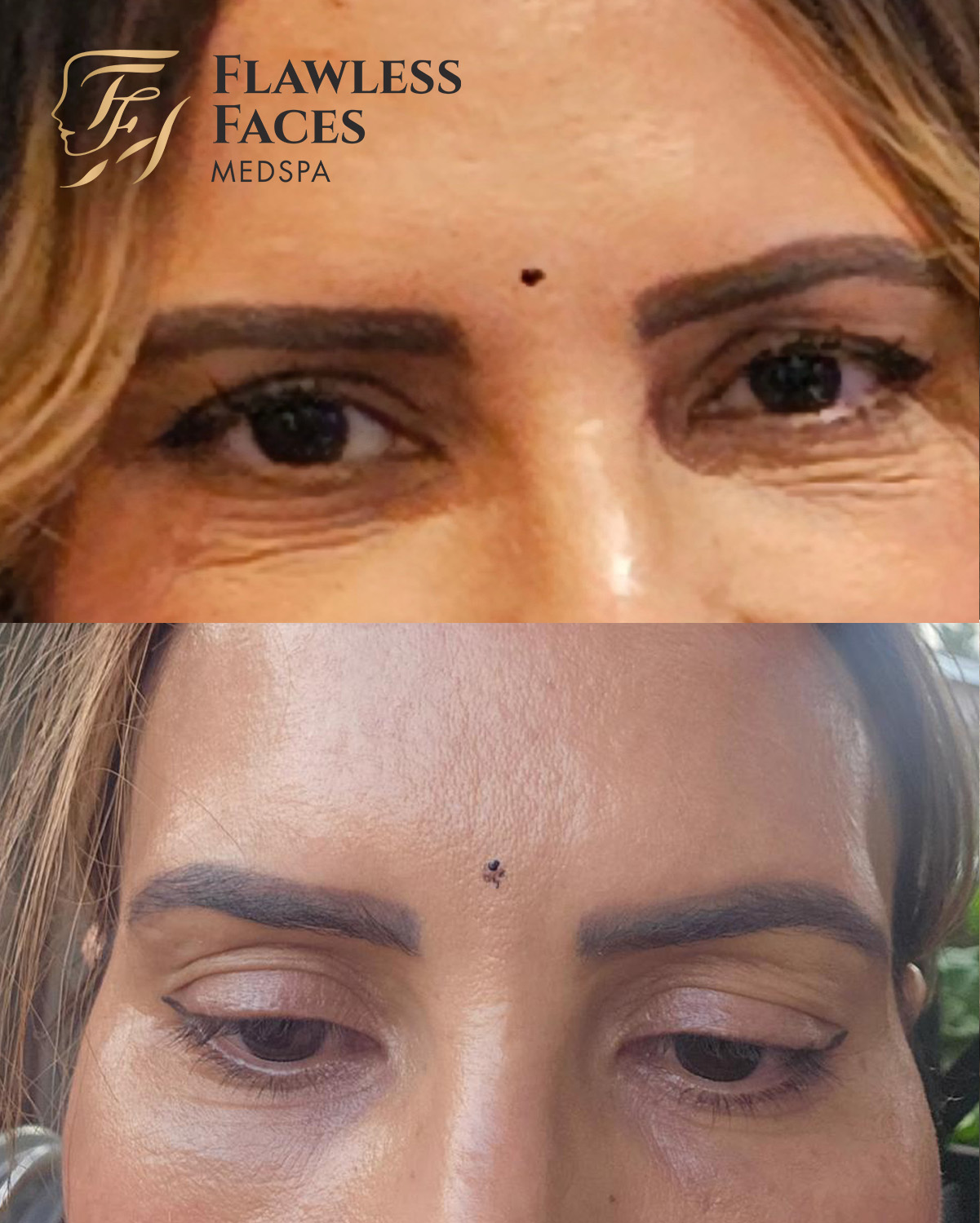 dermal filler under eye (1)