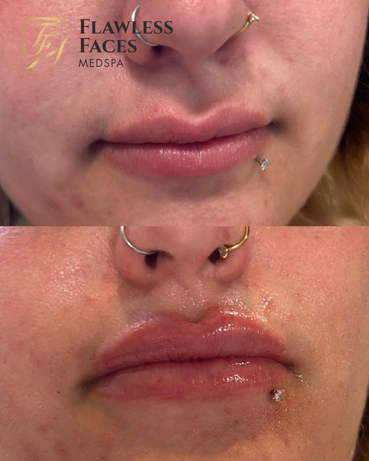 lip filler 18