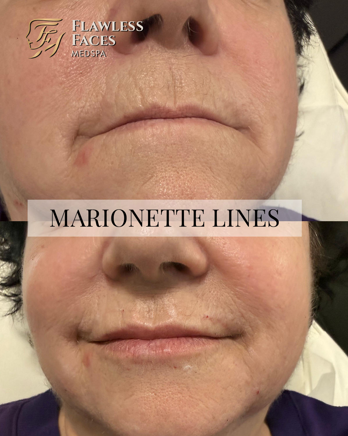 Marionette lines filler 1