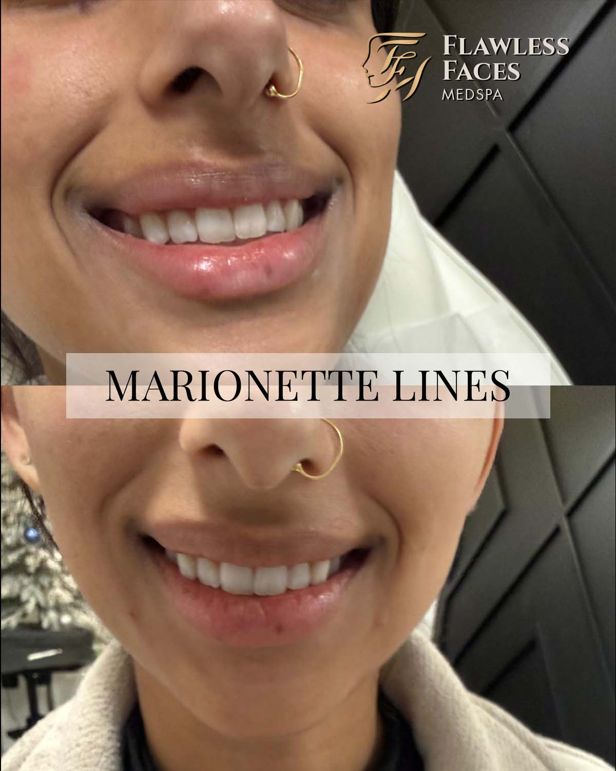 Marionette lines filler