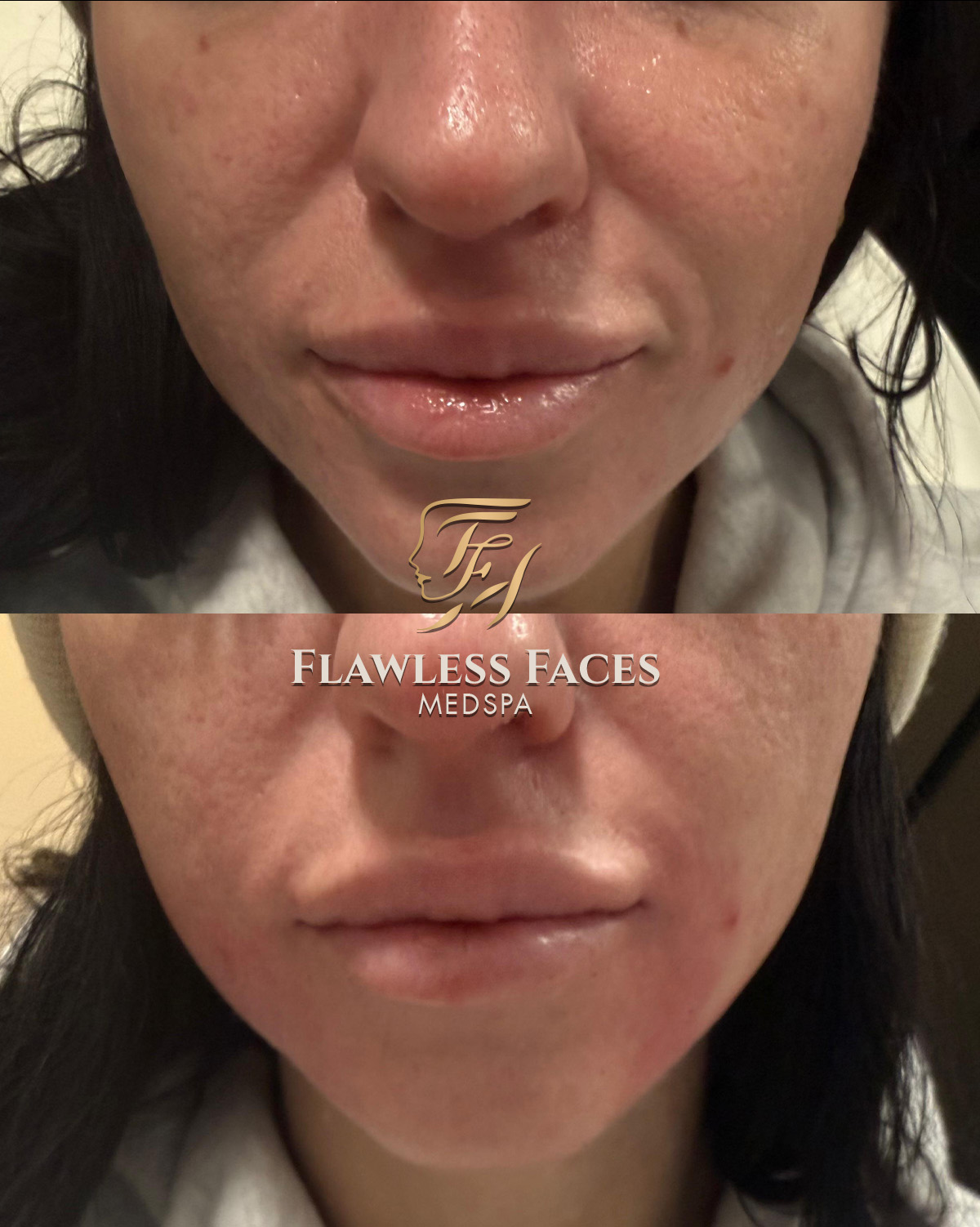 Nasolabial filler (1)