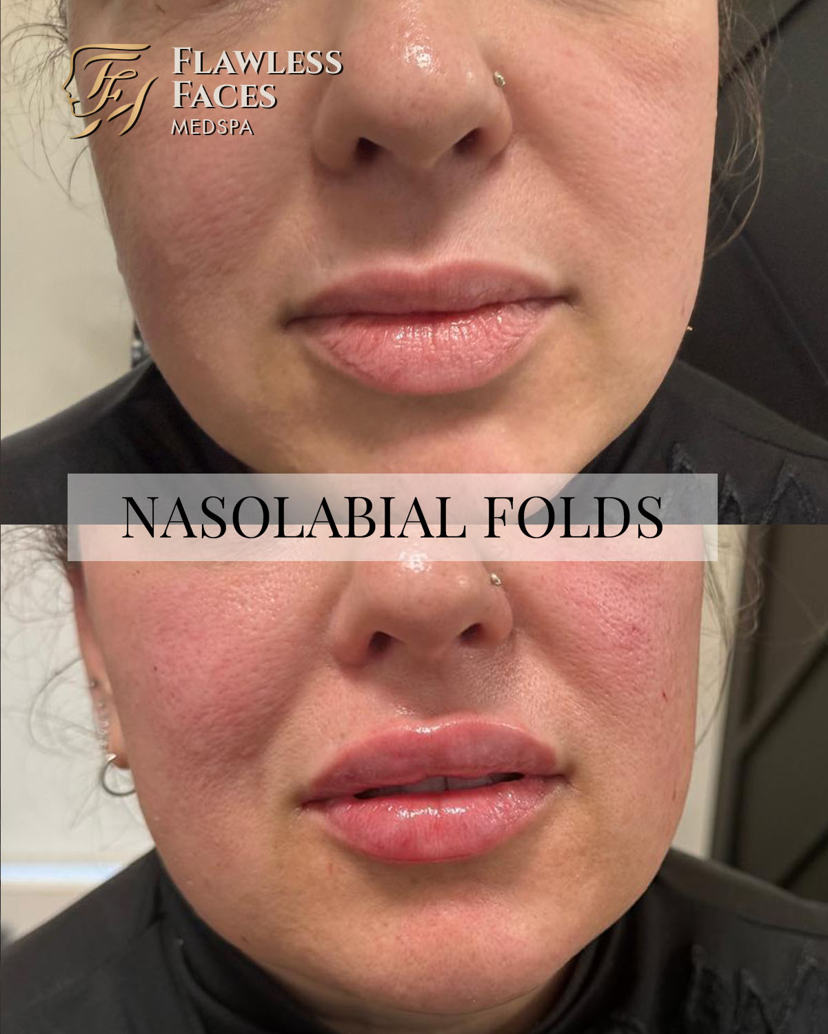 Nasolabial filler 4