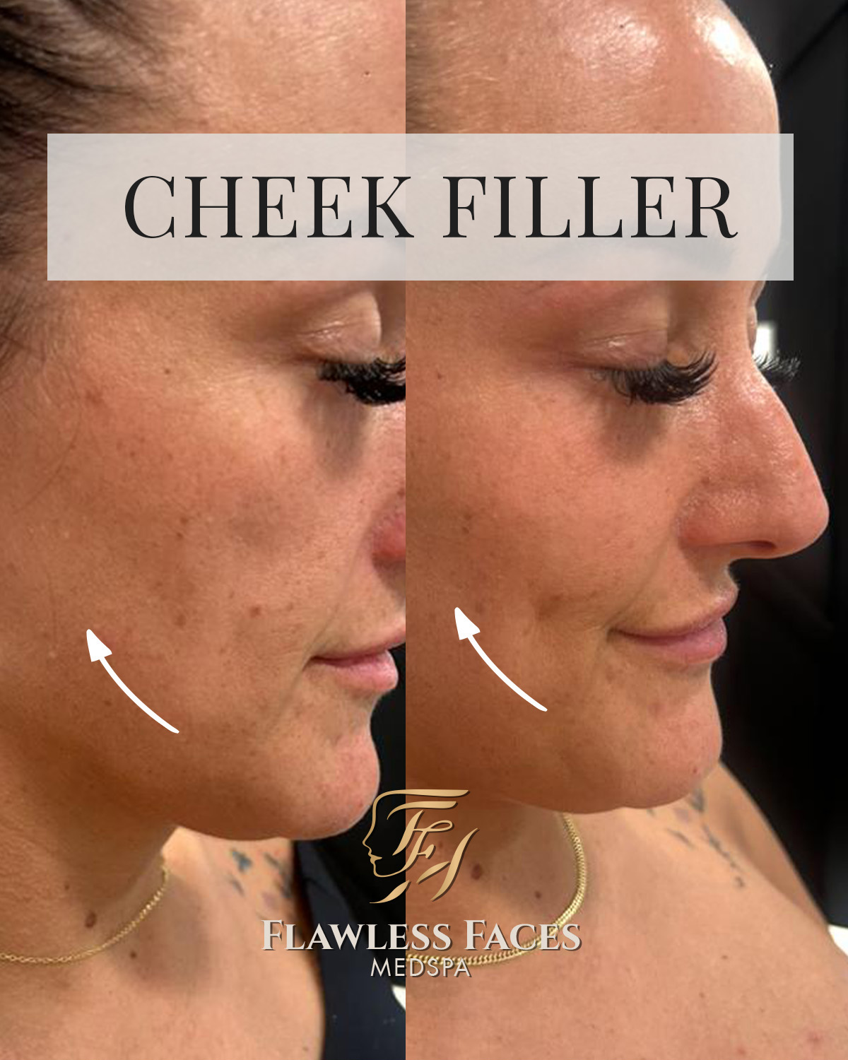 cheek filler