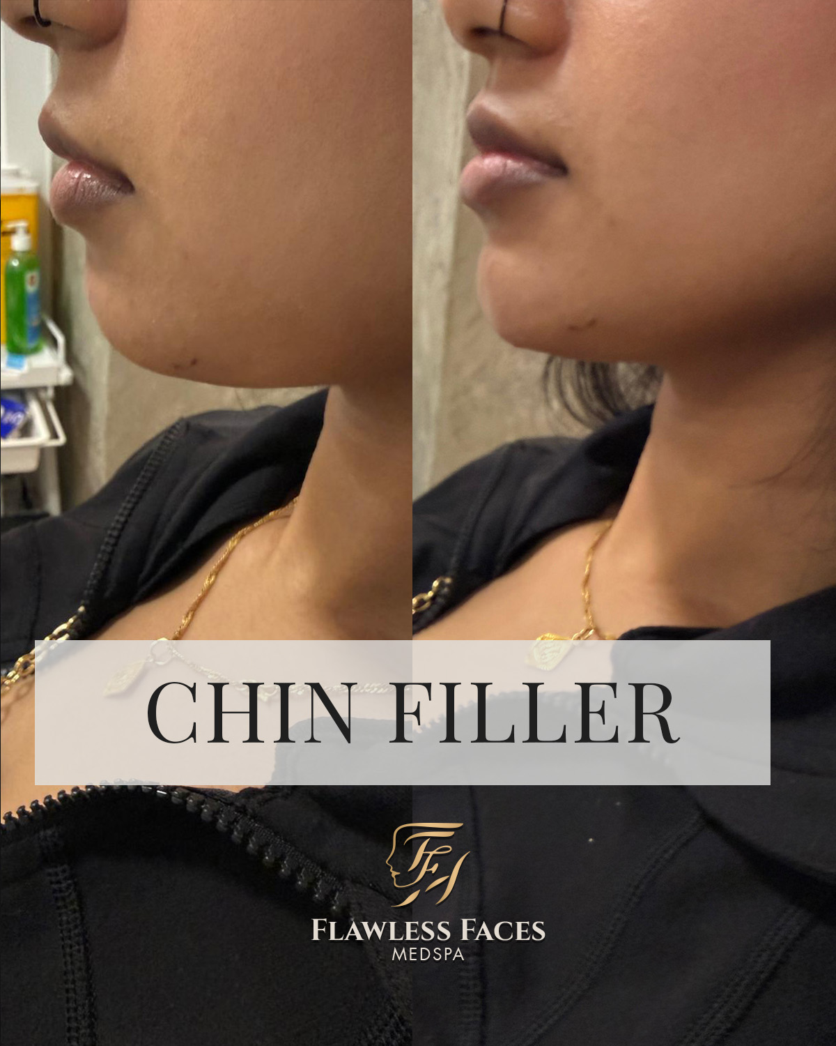 chin filler 1