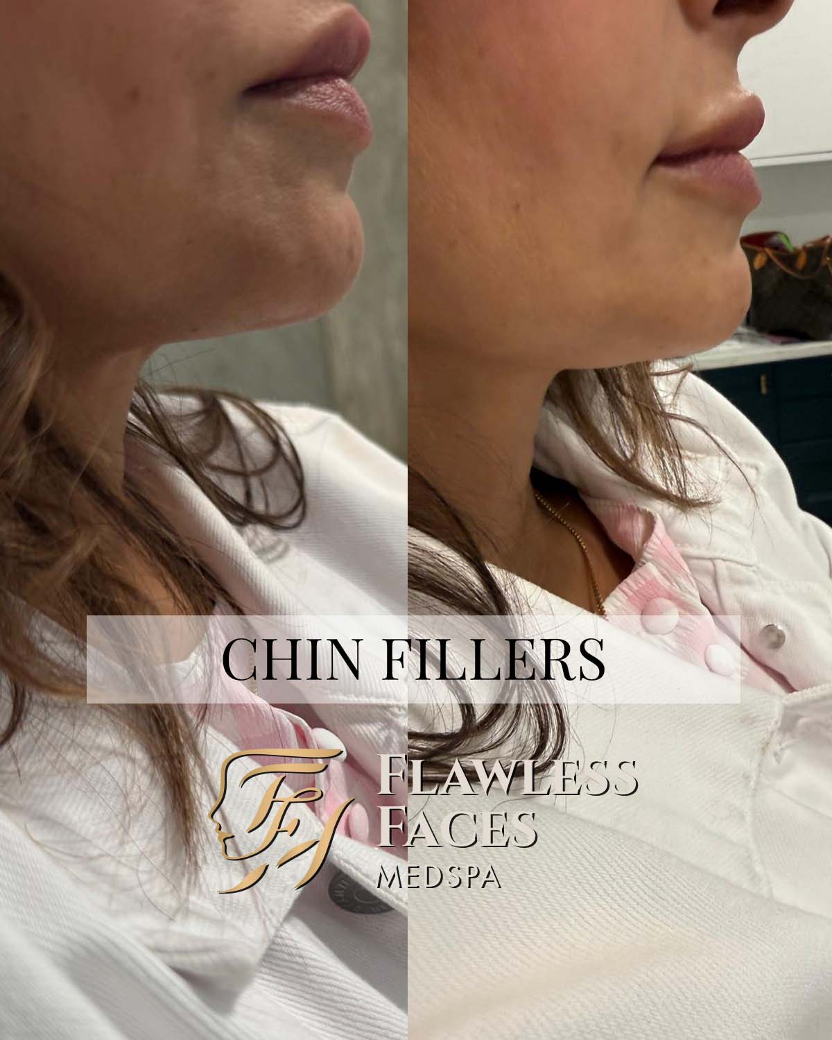 chin filler 3