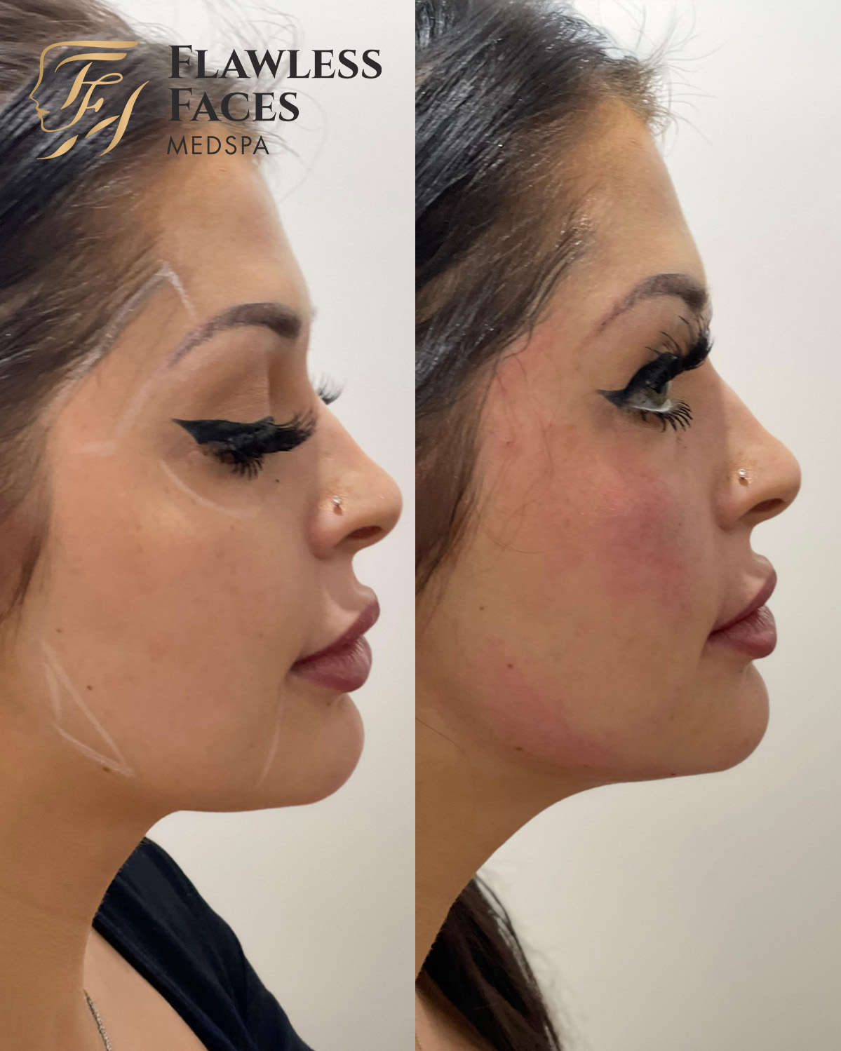 dermal filler 2
