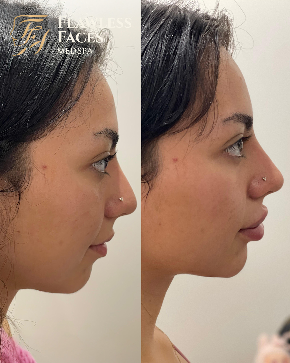 dermal filler