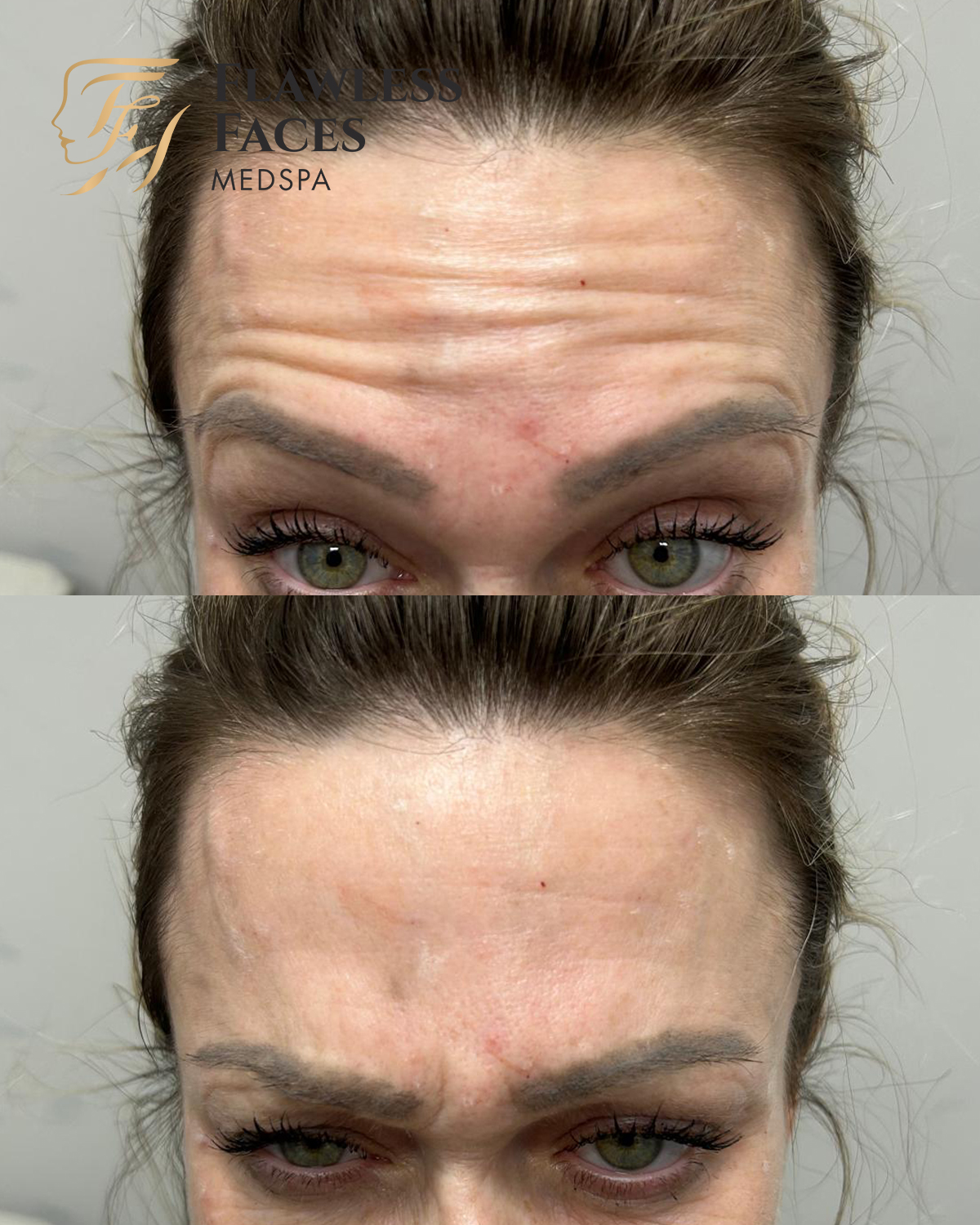 forehead filler 2
