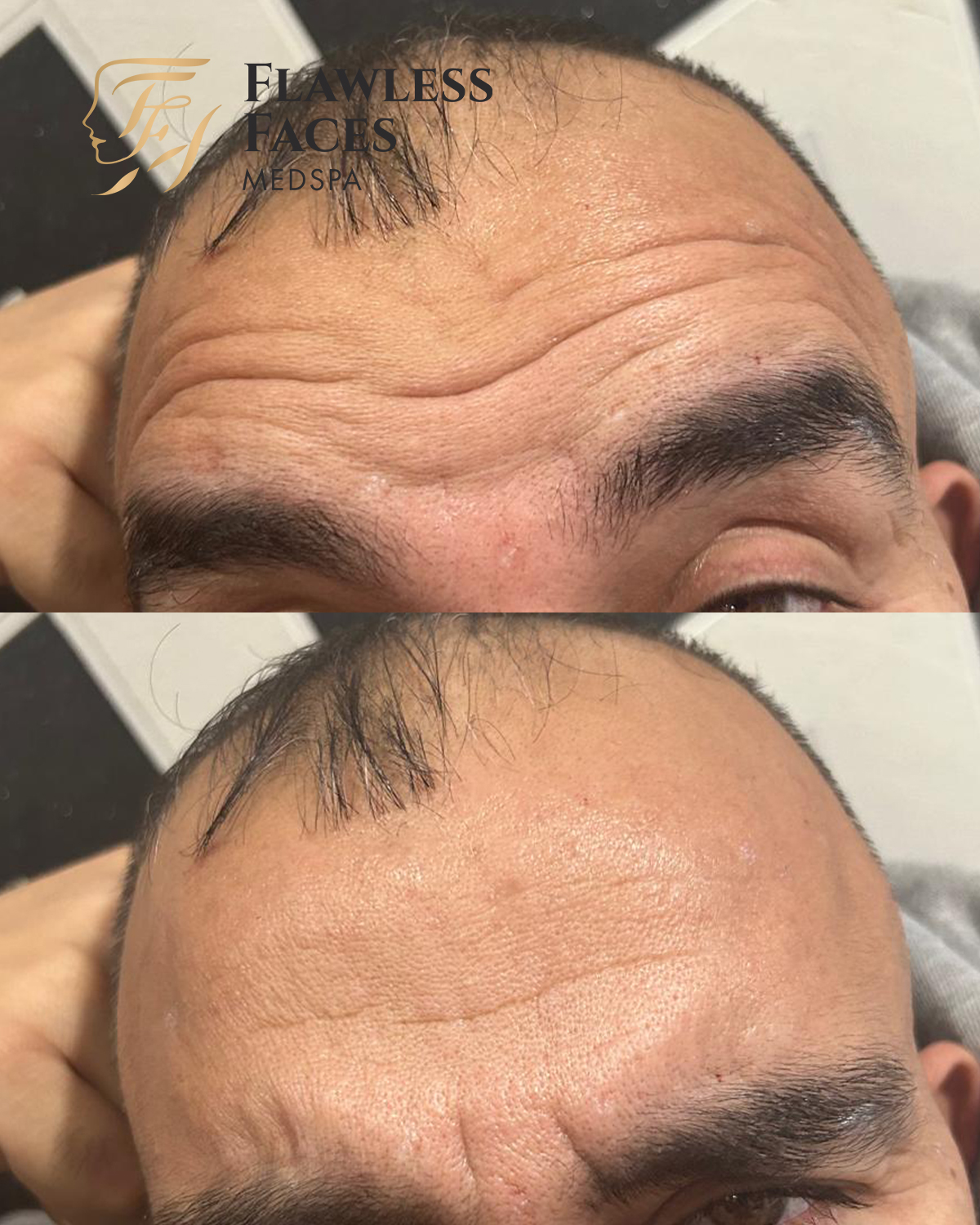 forehead filler 3