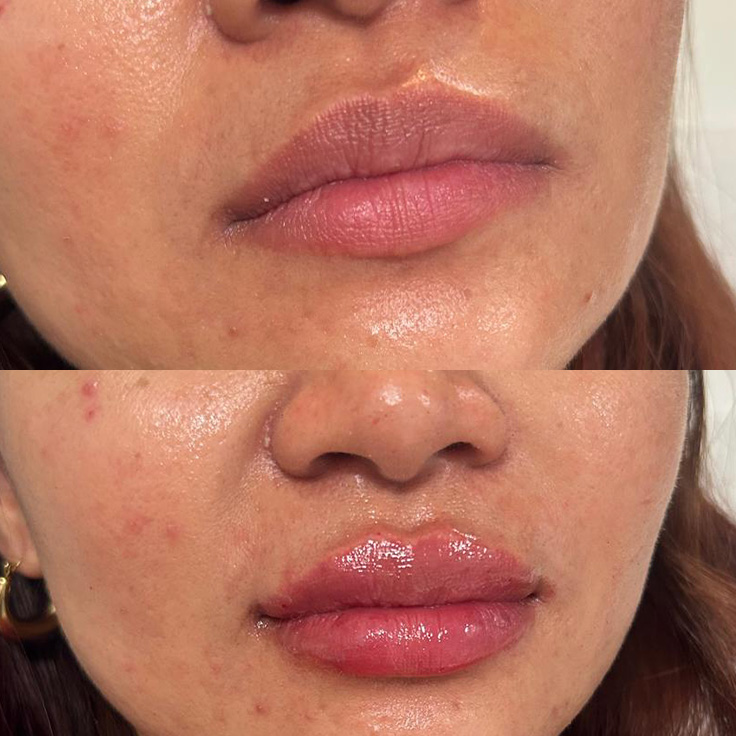 lip fill