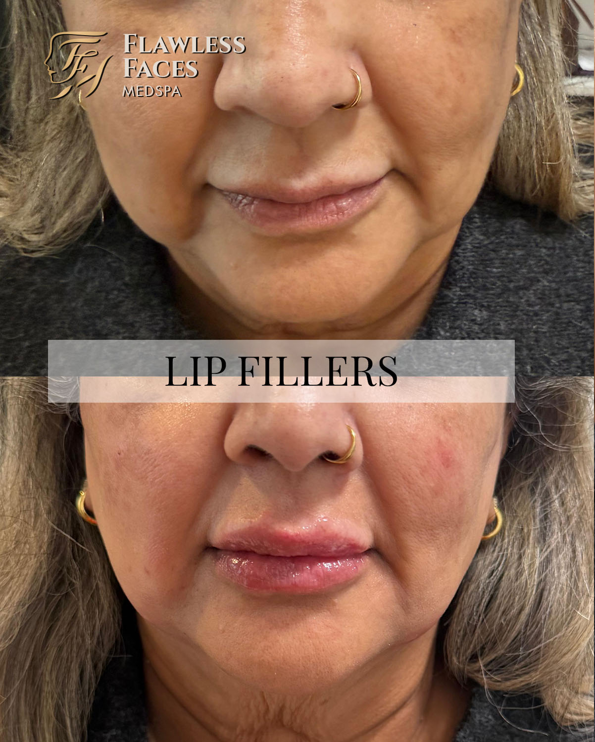 lip filler