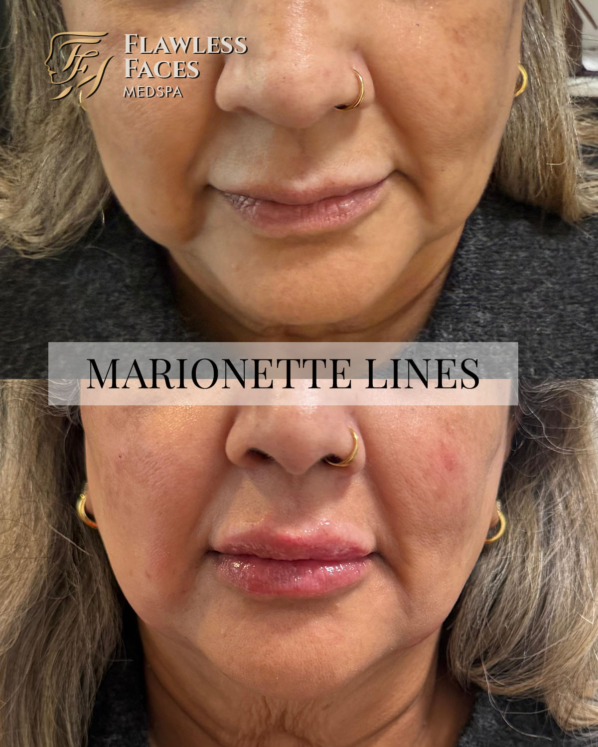 marionette fillers