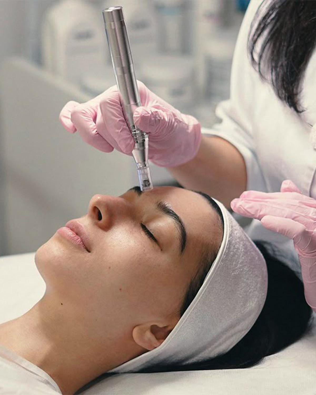 microneedling