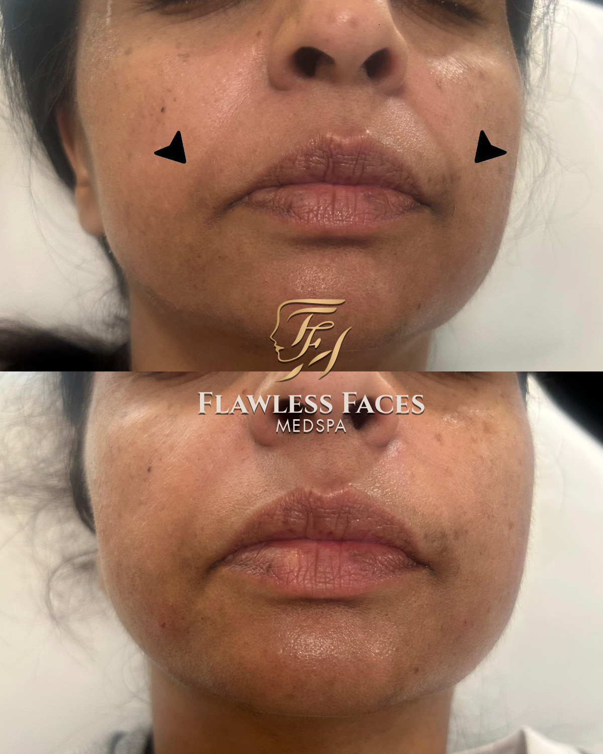 nasolabial fillers 2