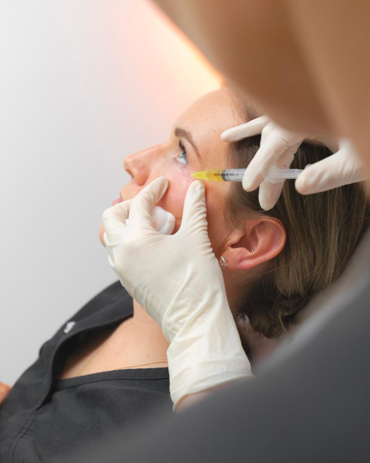 prp facial
