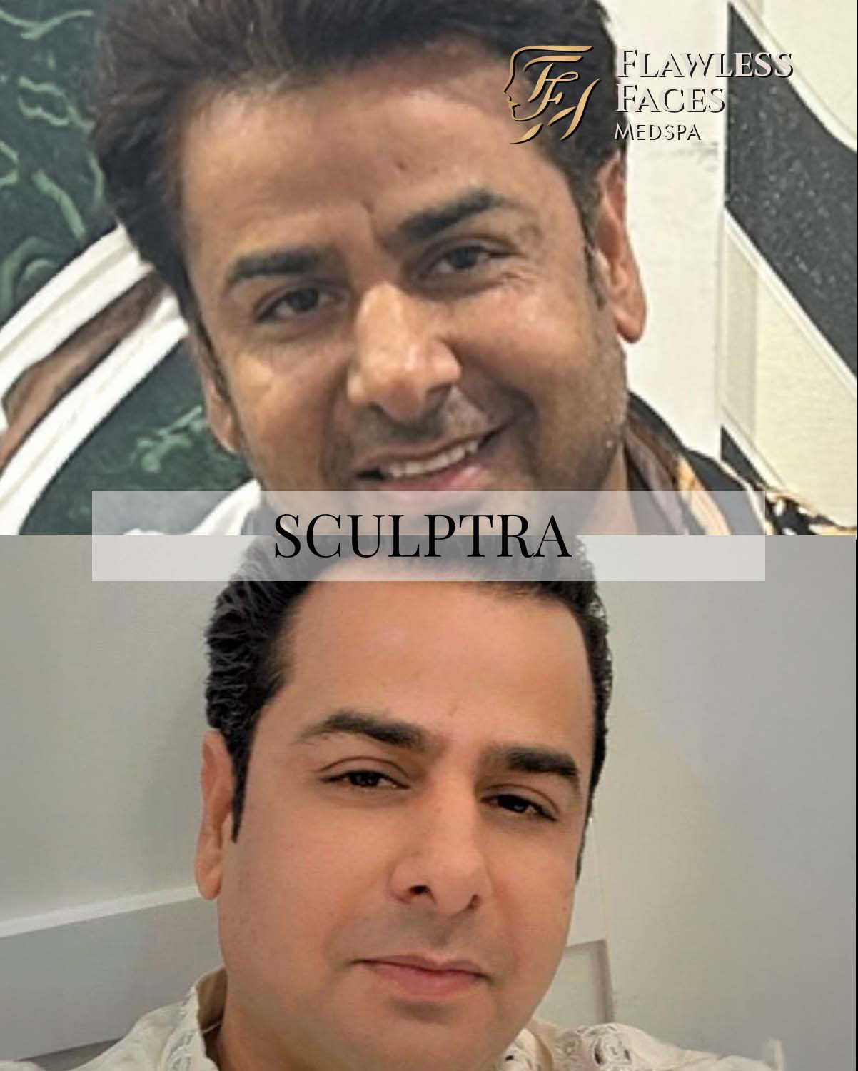 sculptra