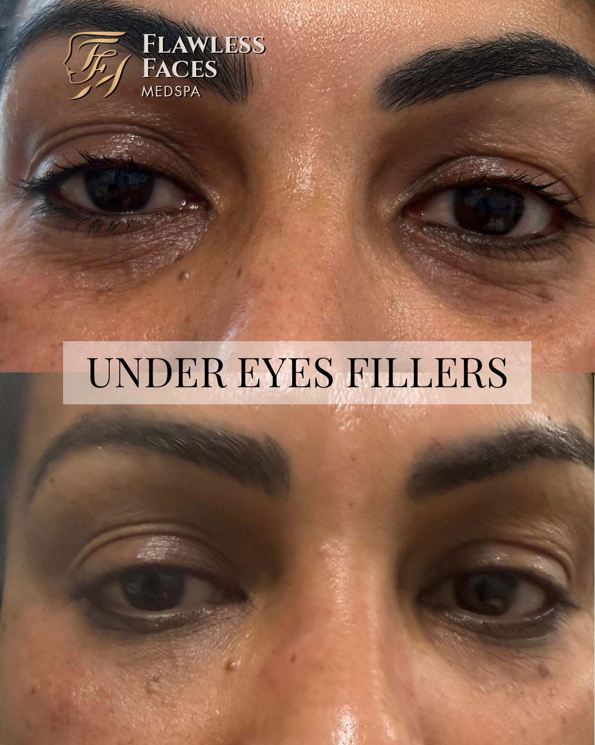 under eyes filler