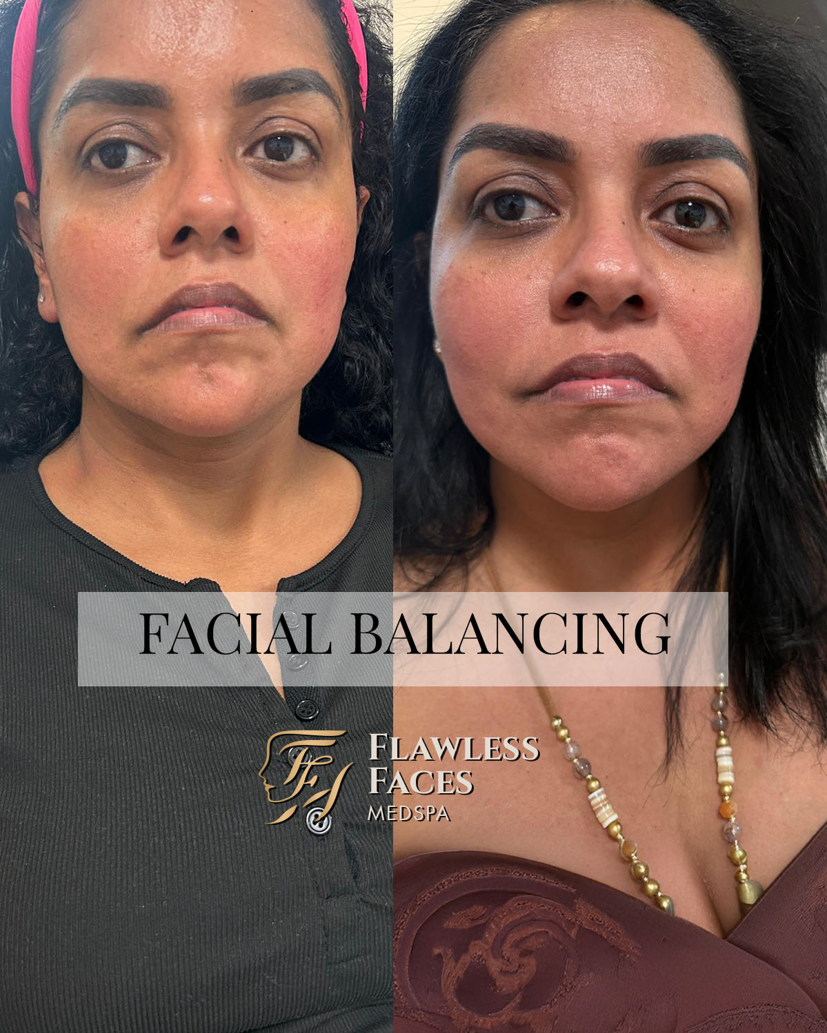 cheek chin jawline filler 1