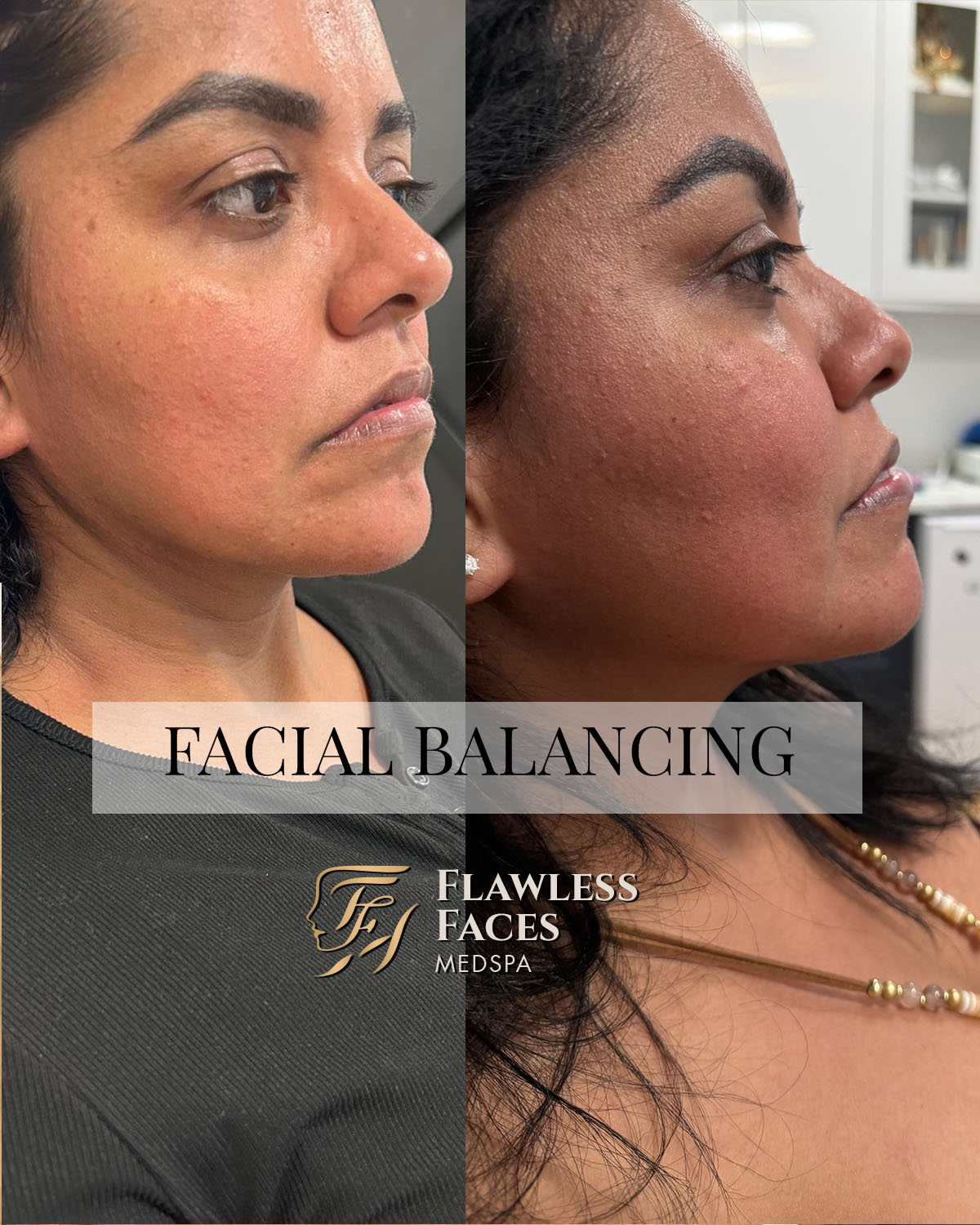 cheek chin jawline filler 2