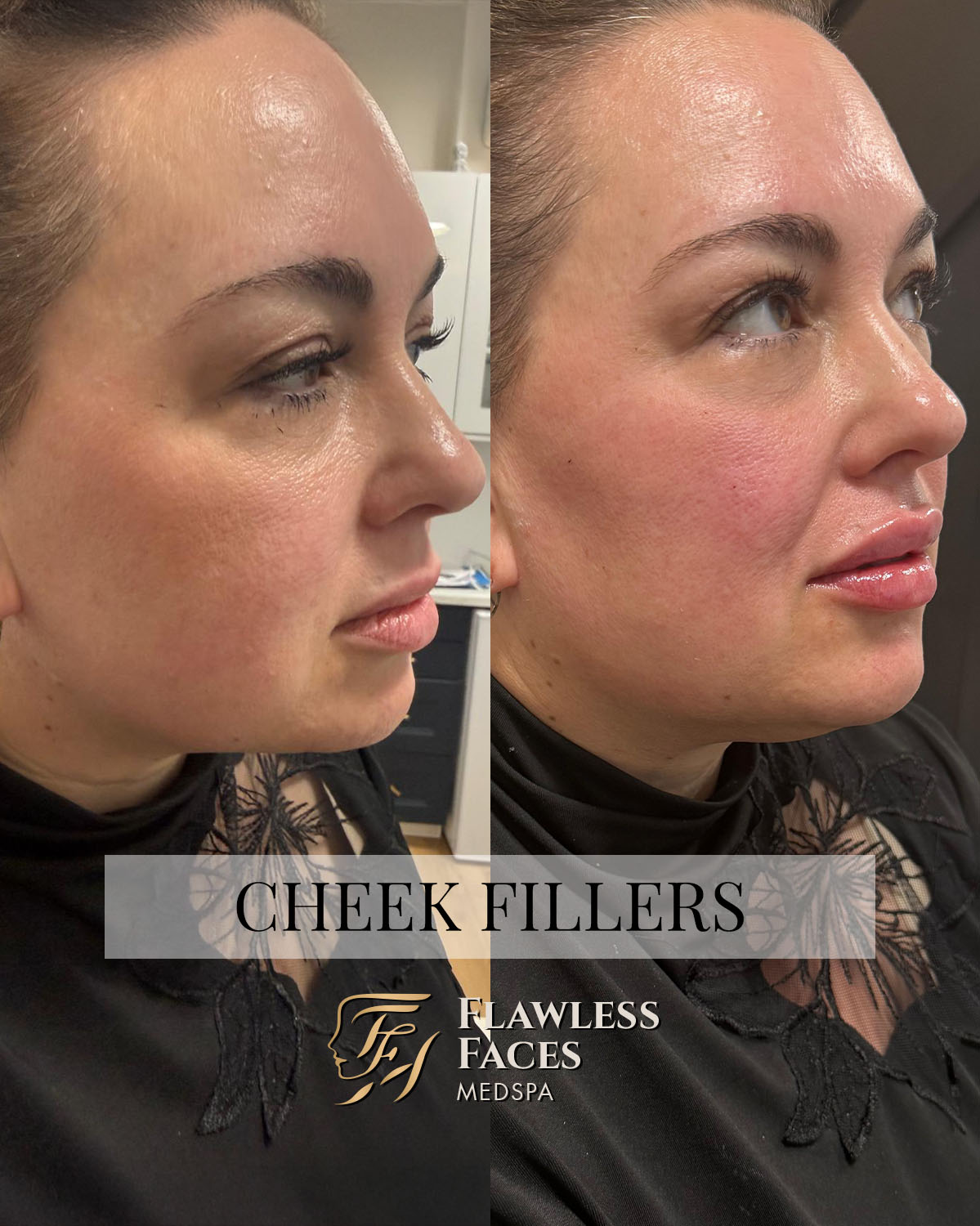 cheek filler 2
