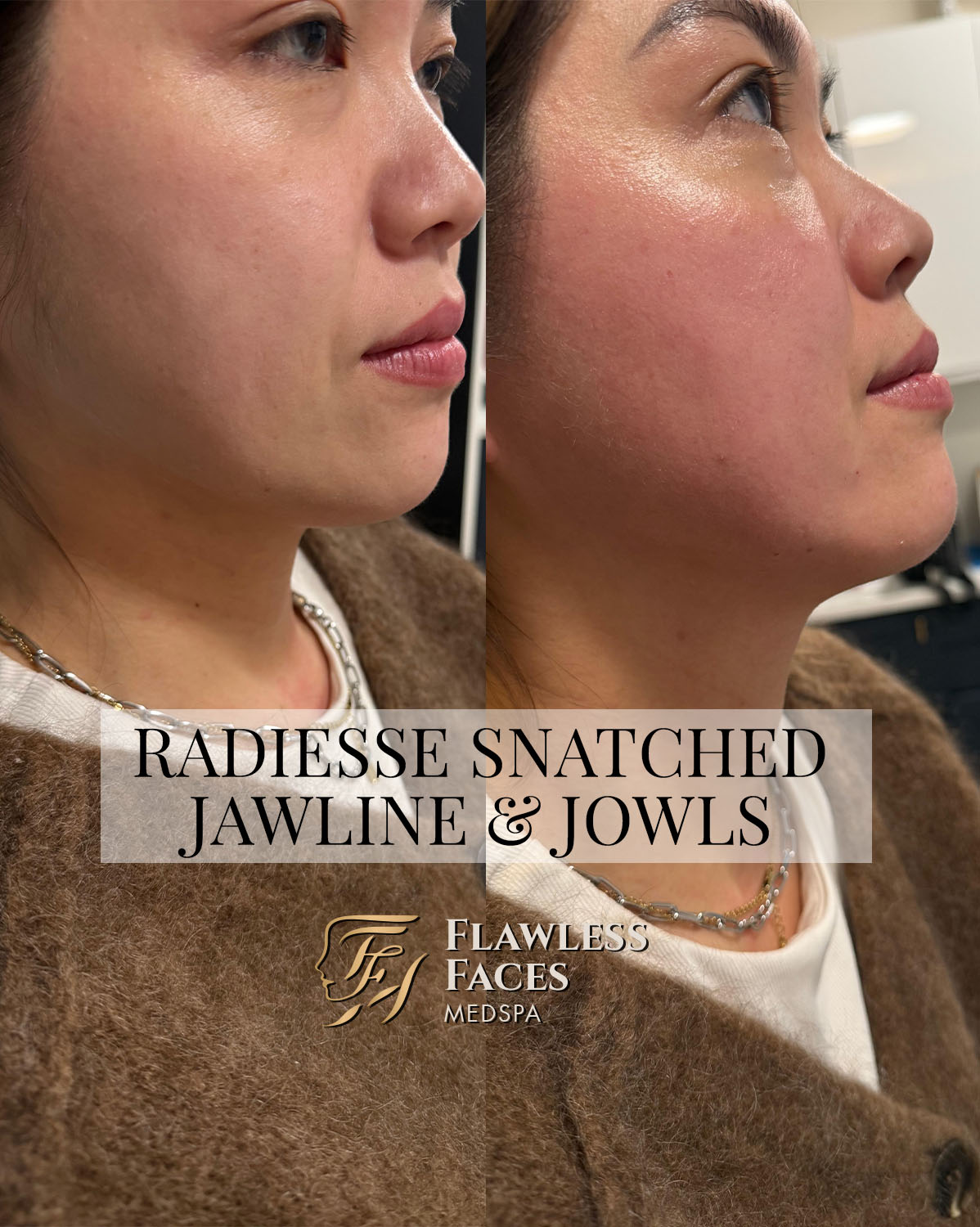 FEB RADIESSE JAELINE & JOWLS 1