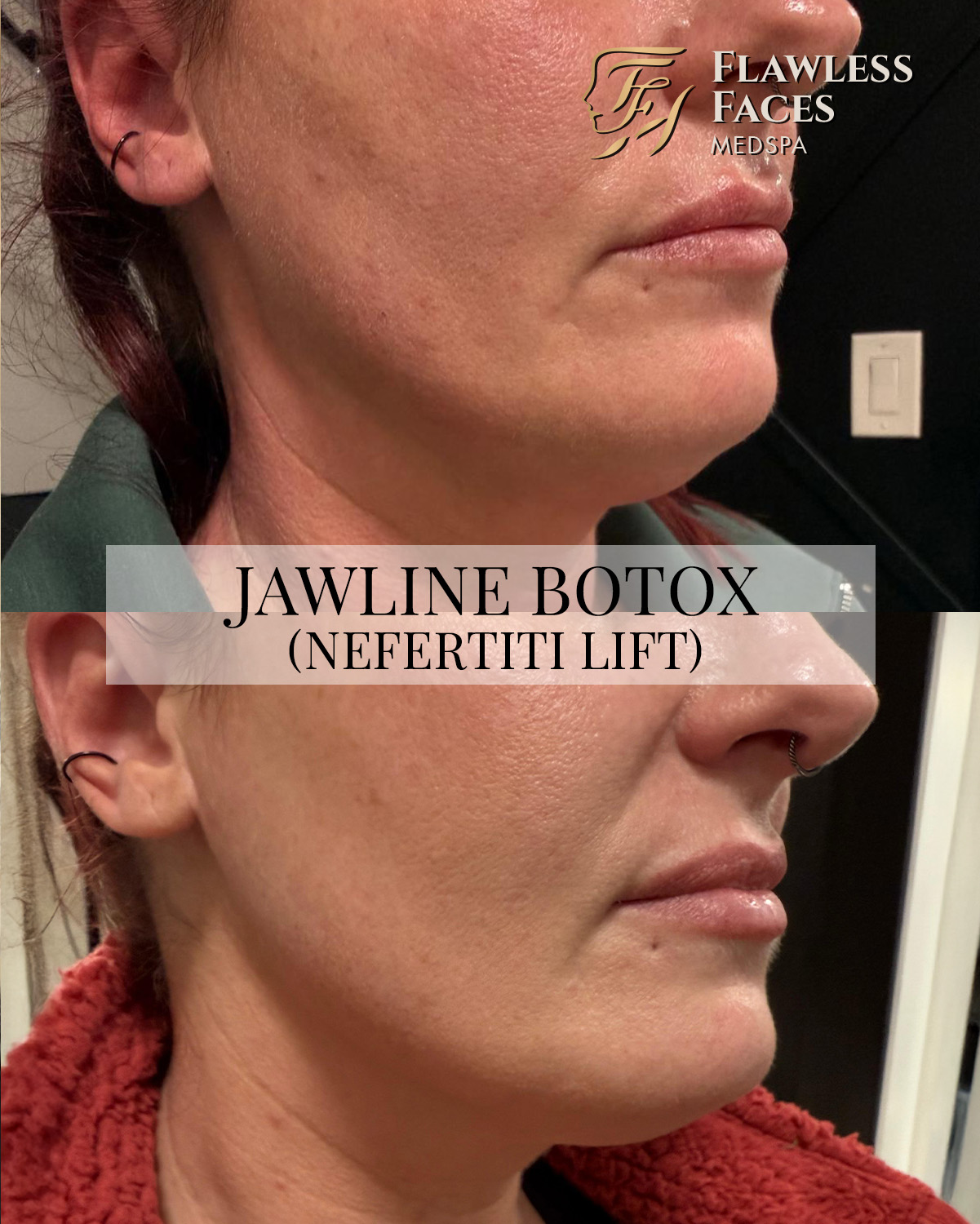 FEB jawline botox 1