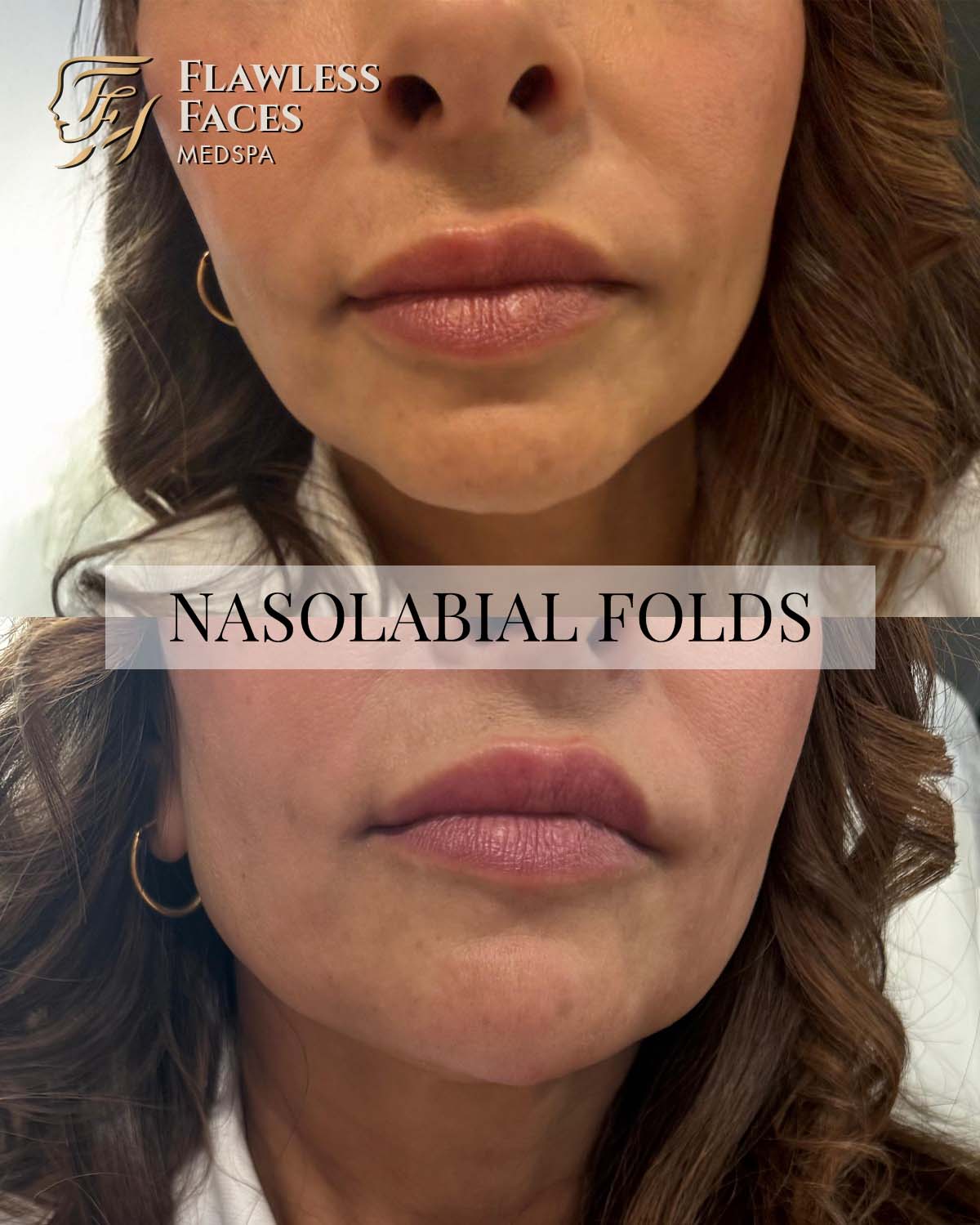 JAN Nasolabial filler 2