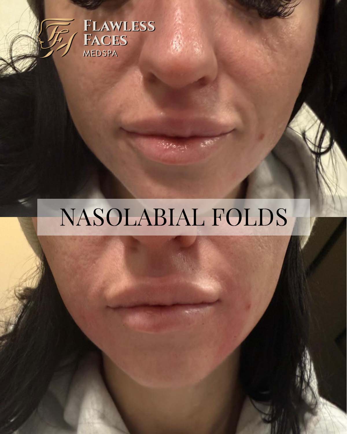 JAN Nasolabial filler 3