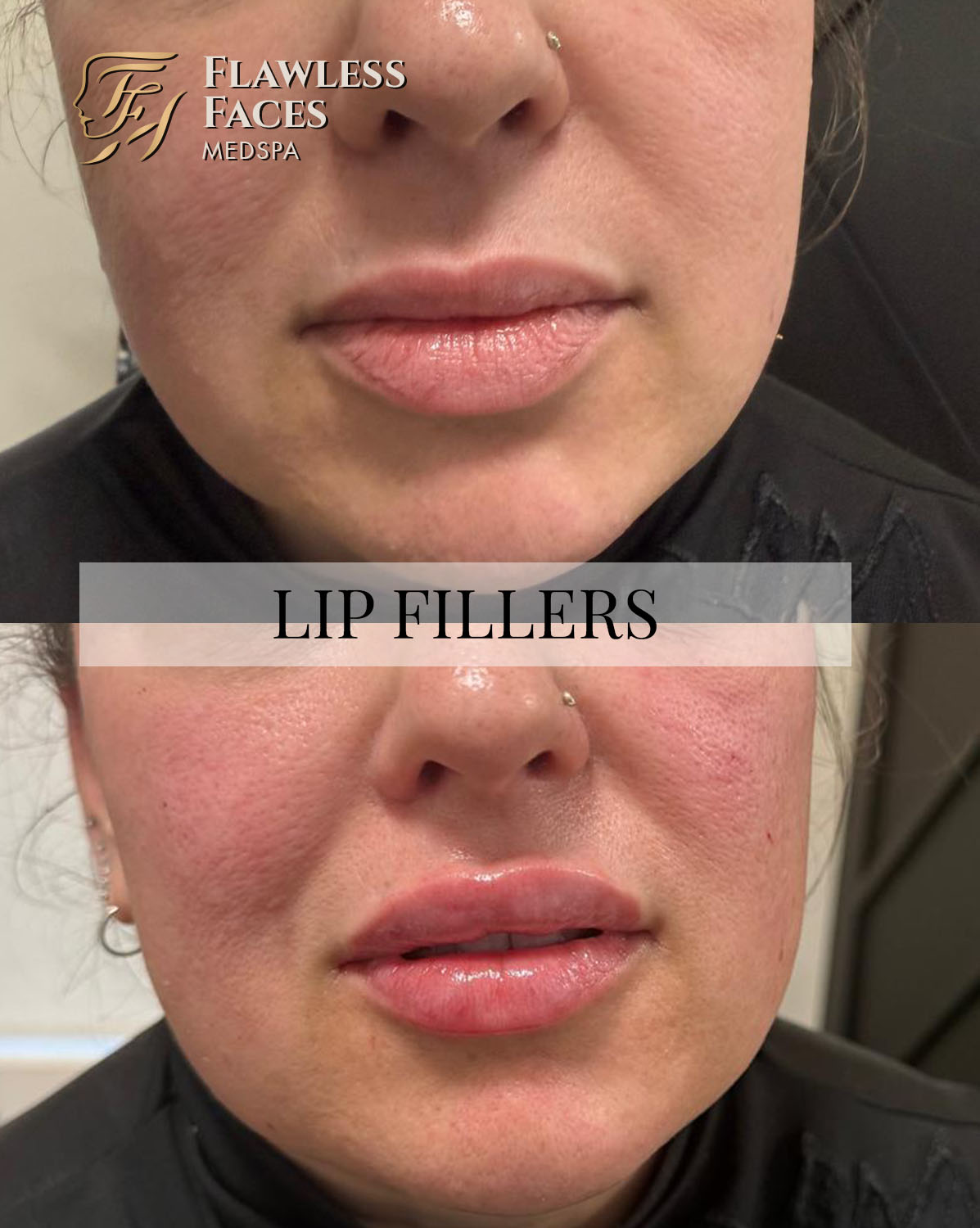 JAN lip filler 23