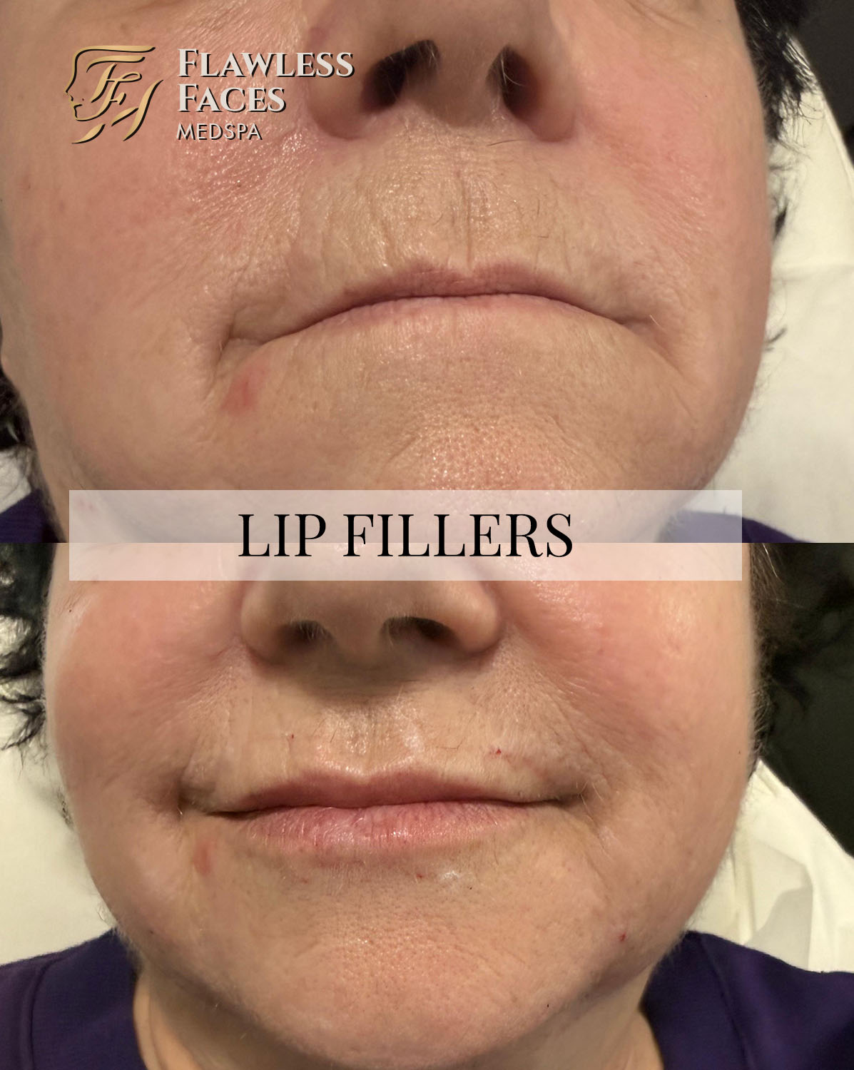 JAN lip filler 24