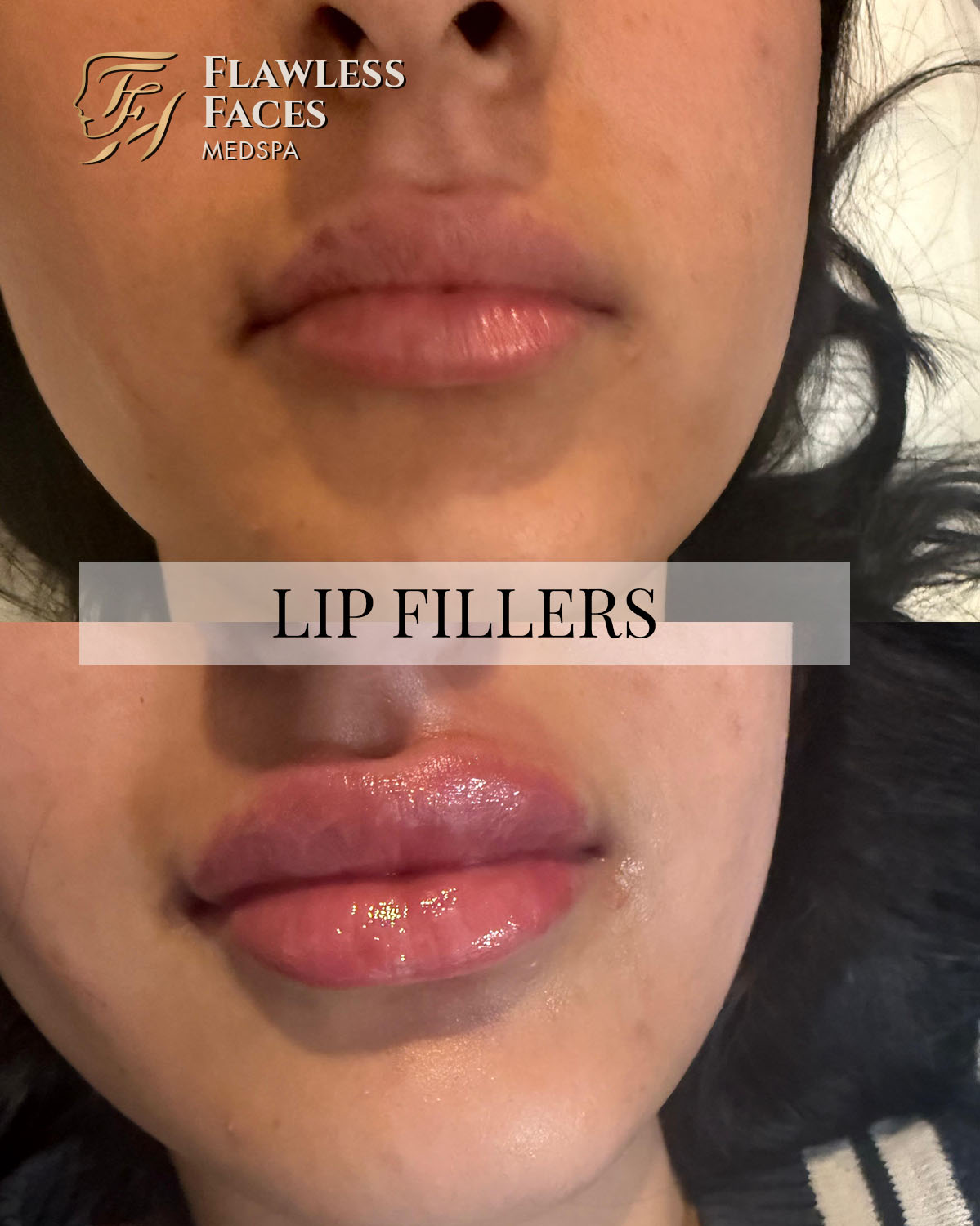 JAN lip filler 25