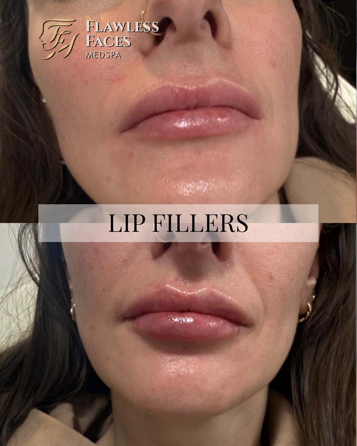 JAN lip filler 30