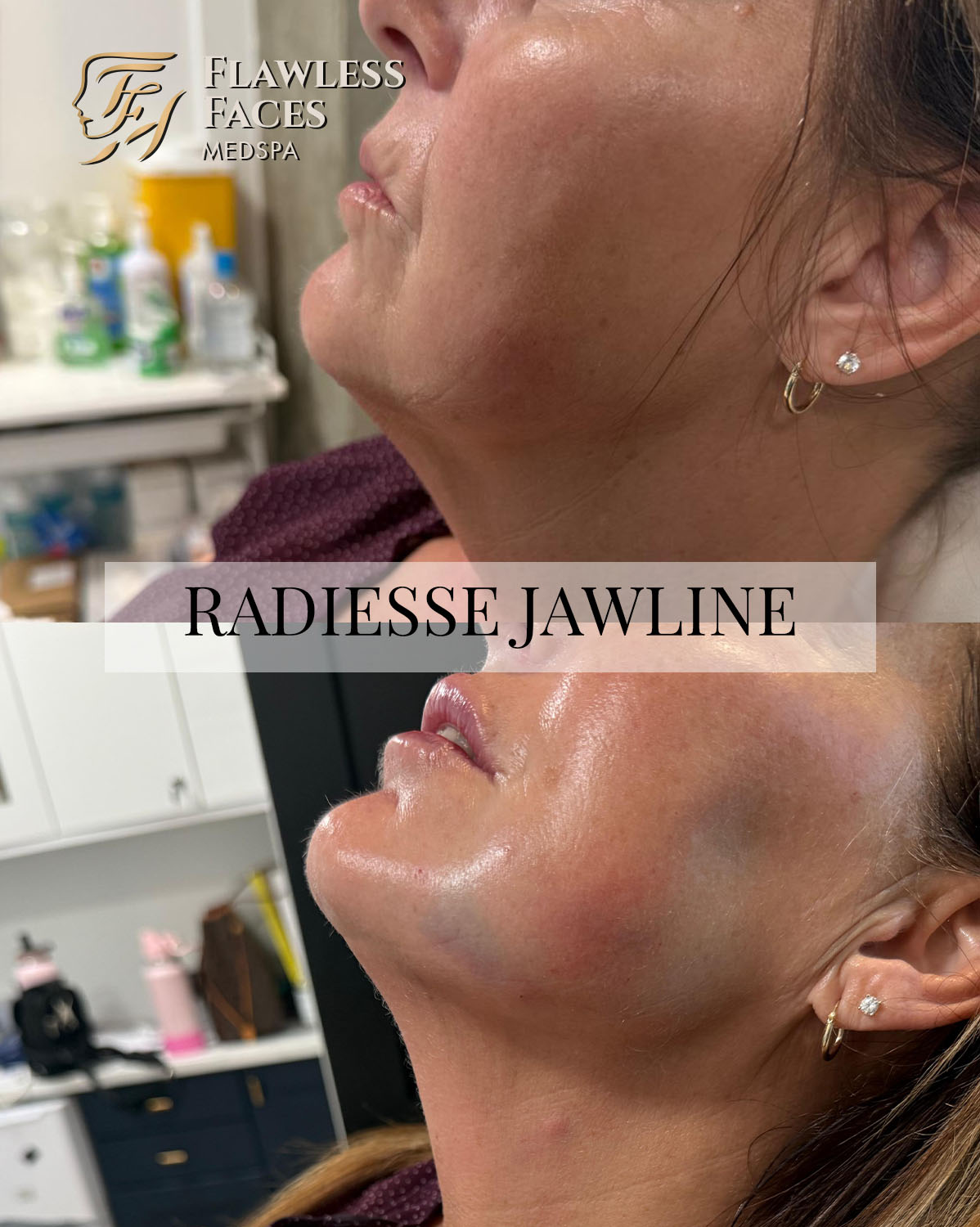 JAN radiesse jawline 1