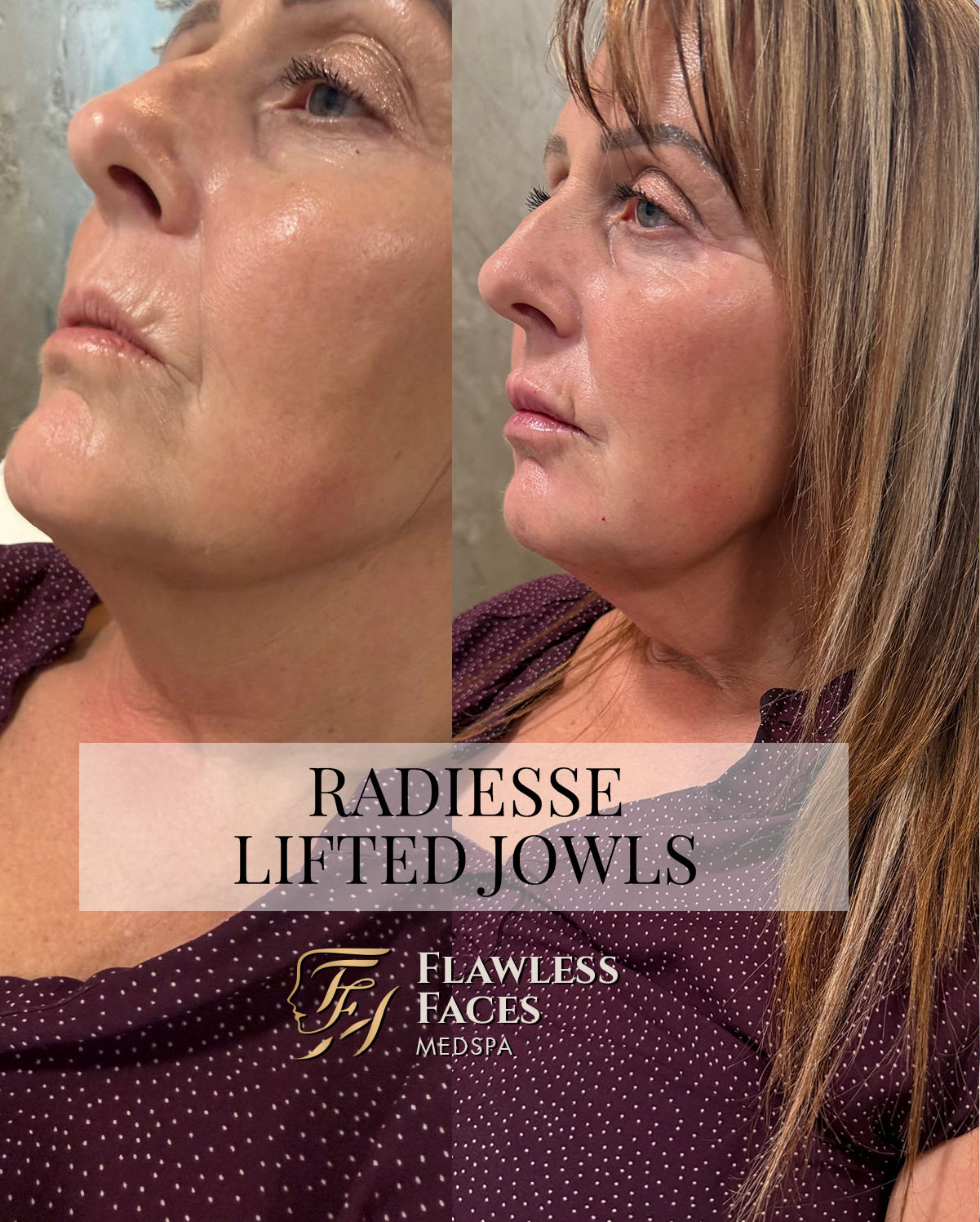 JAN radiesse lifted jowls 1