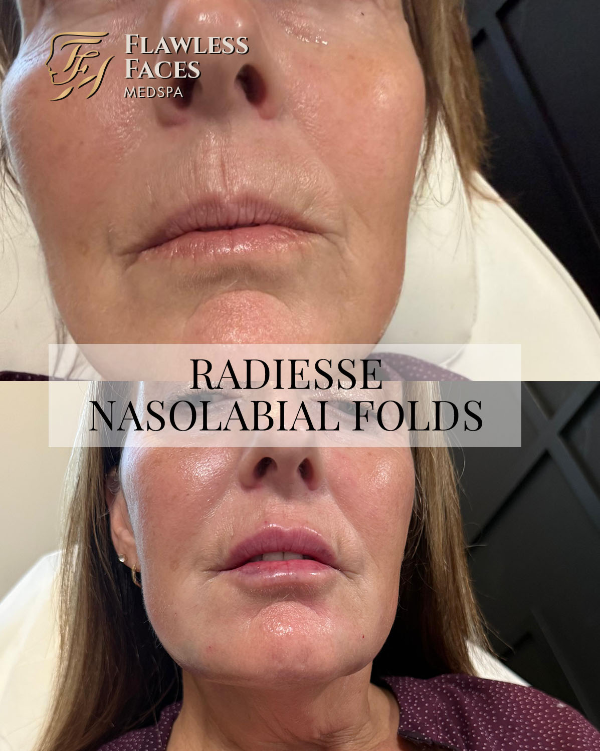 JAN radiesse nasolabial folds 1