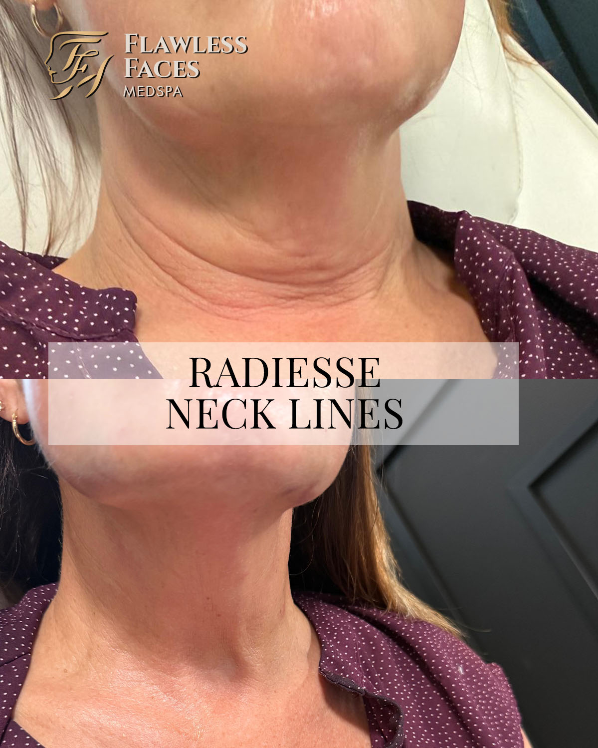 JAN radiesse neck lines 1