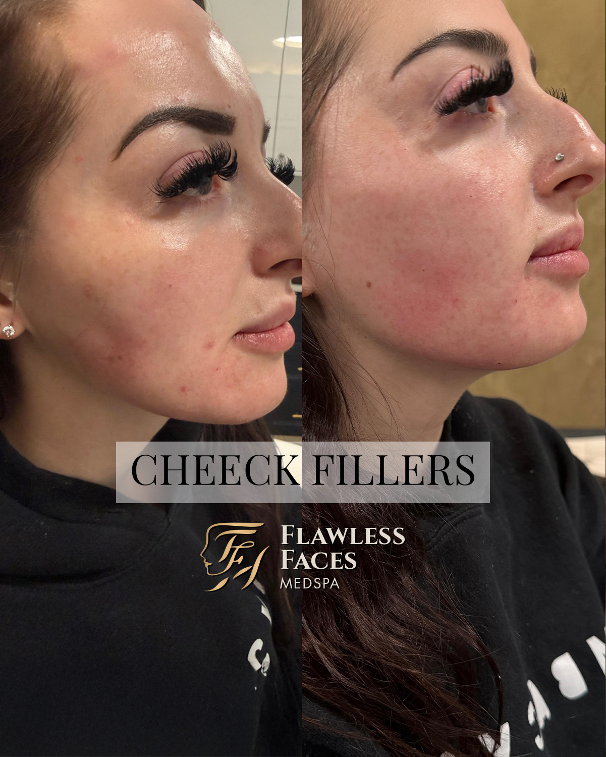 MAR cheek filler 1