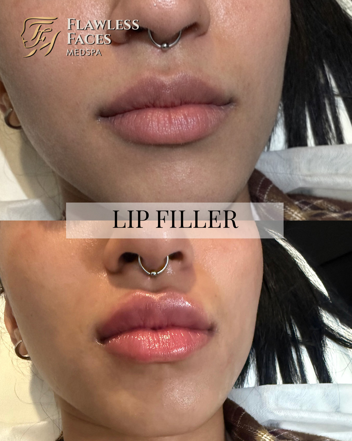 MAR lip filler 1
