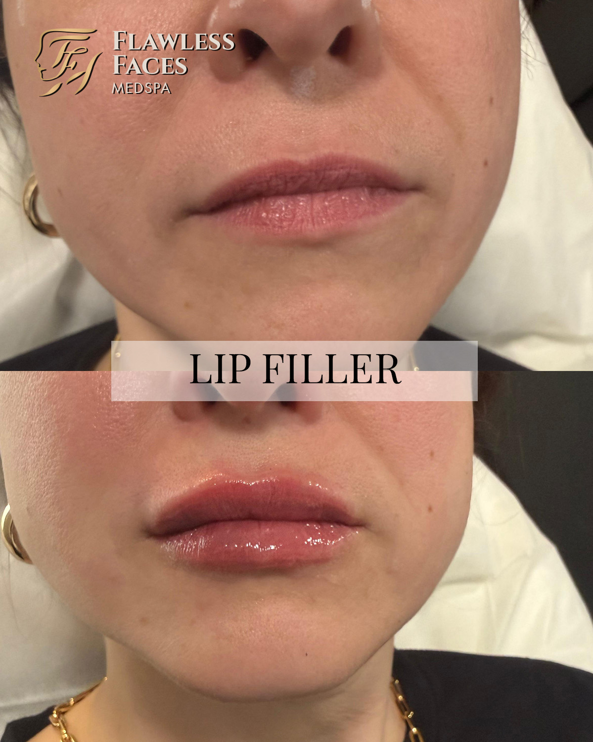 MAR lip filler 2