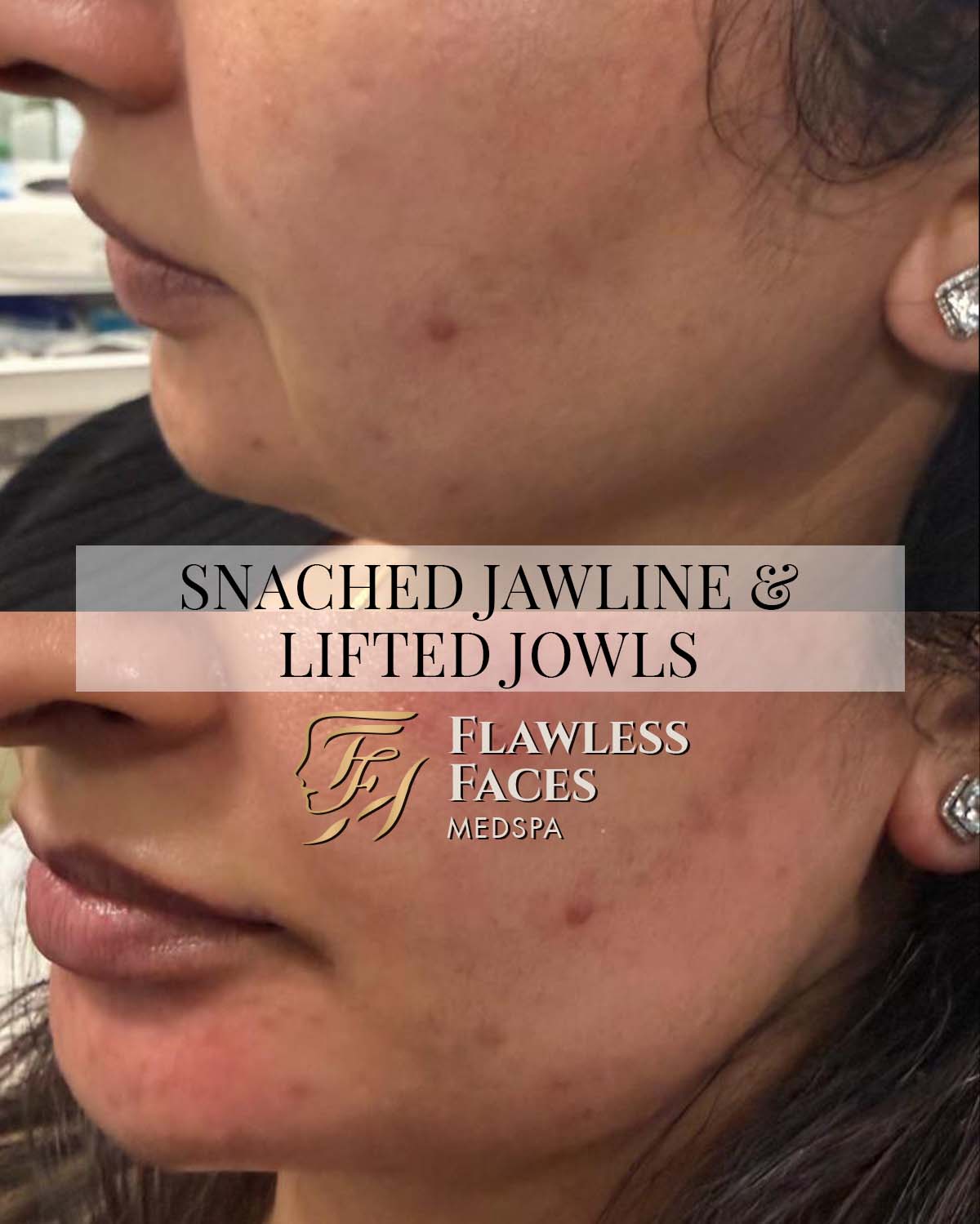 RADIESSE JAELINE & JOWLS 2