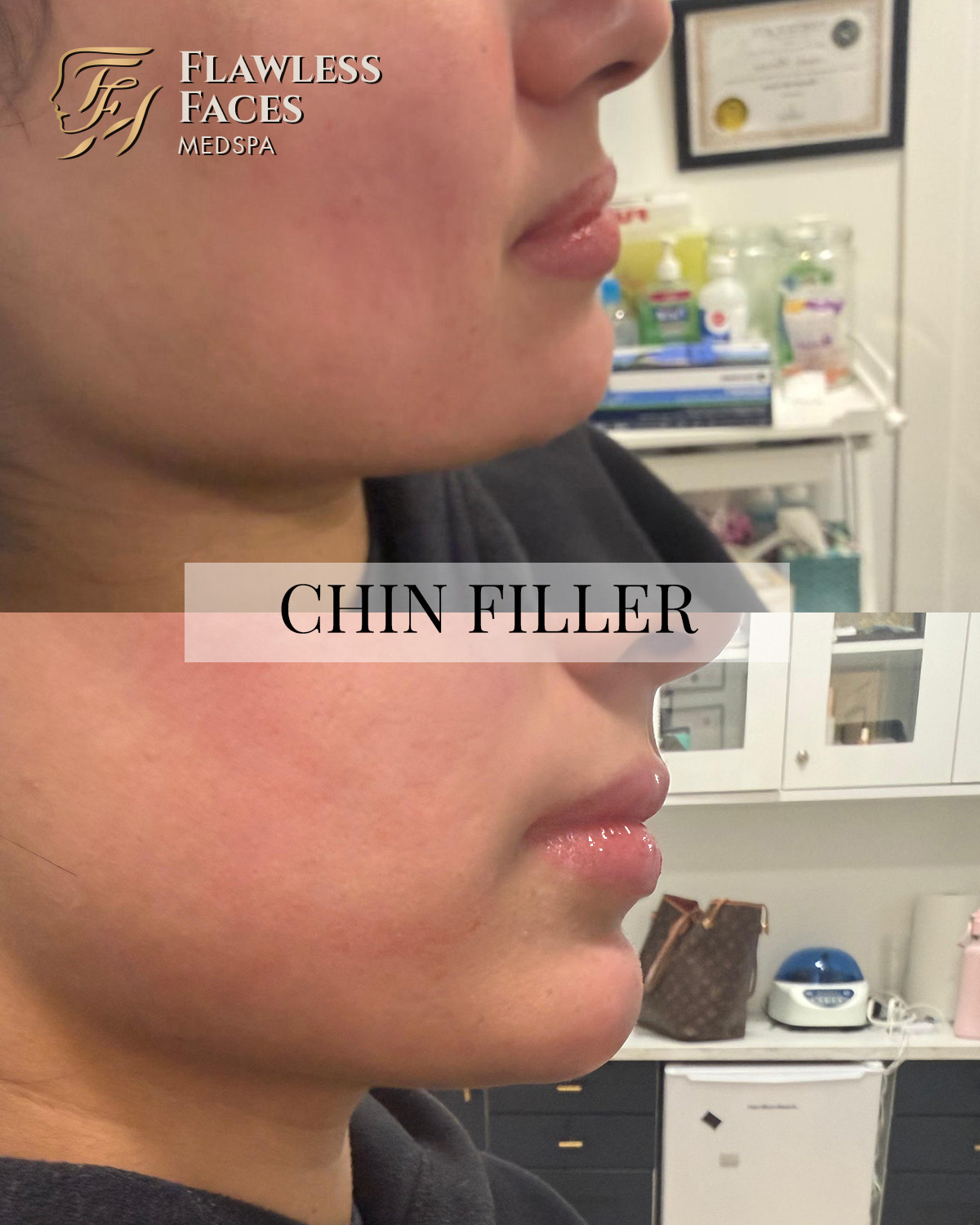APRIL chin filler