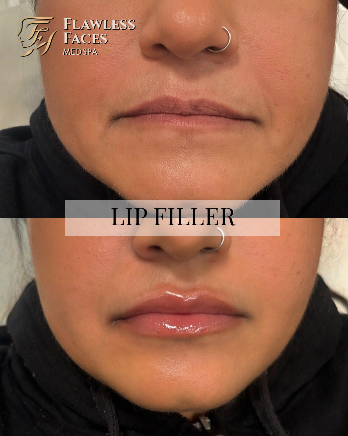 APRIL lip filler 1