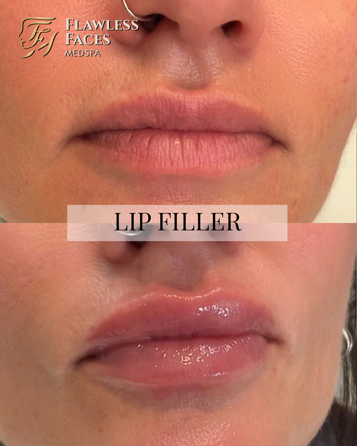 APRIL lip filler 2