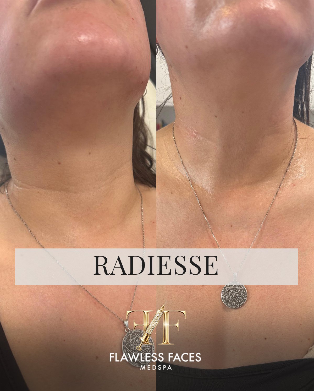 AUG radiesse 2