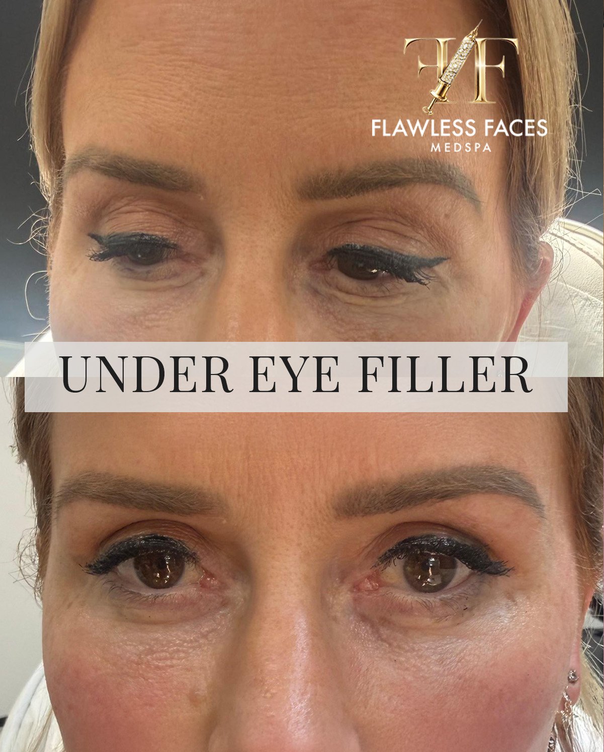 AUG under eye filler 1