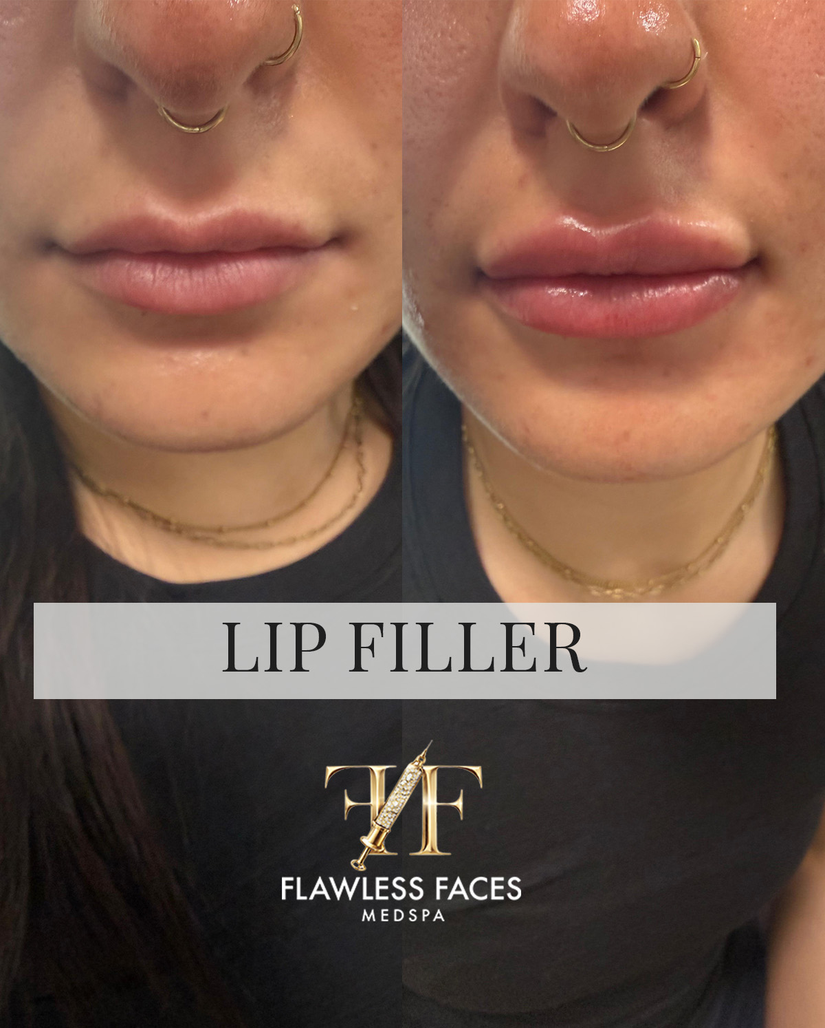 July lip filler 1