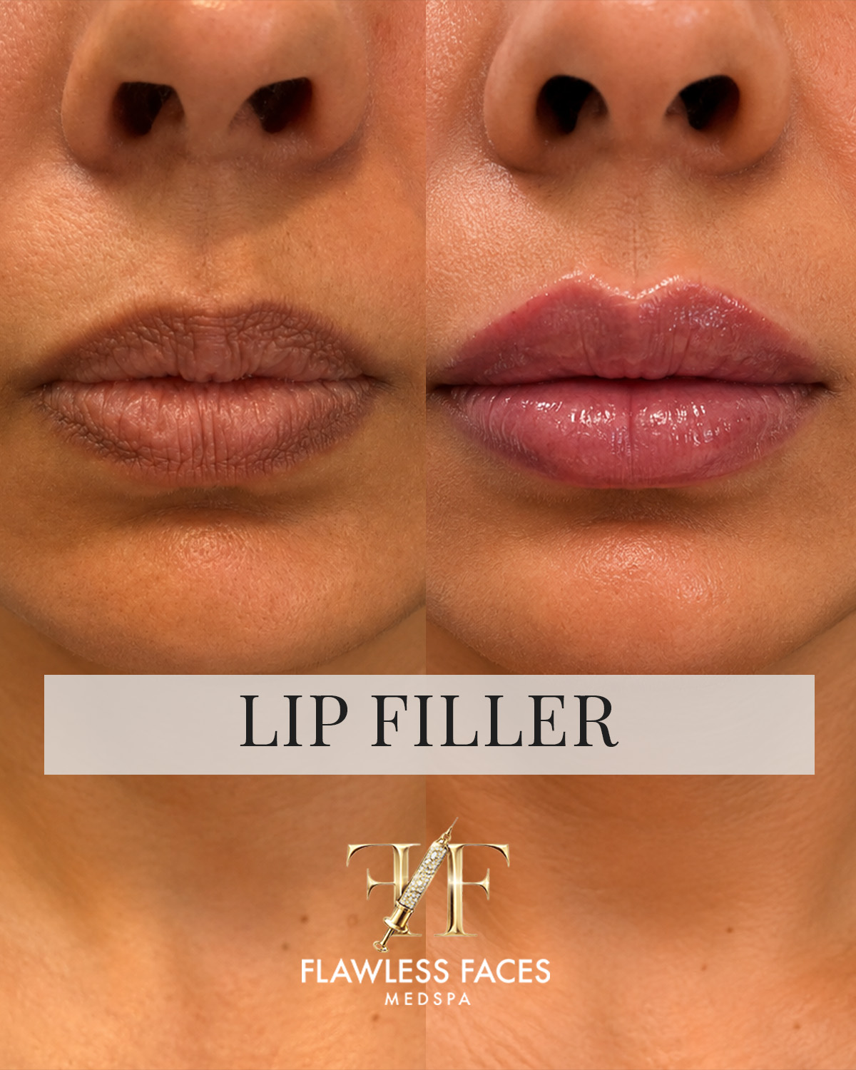 July lip filler 2