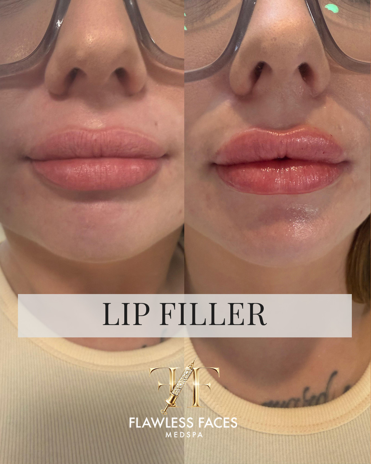 July lip filler 3