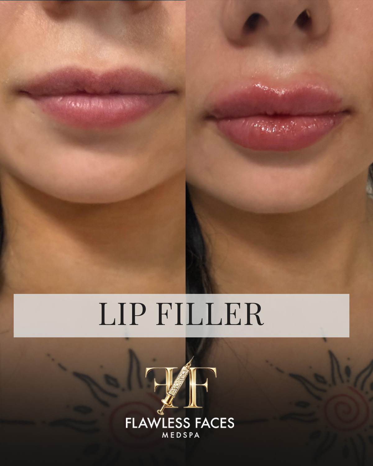 July lip filler 4