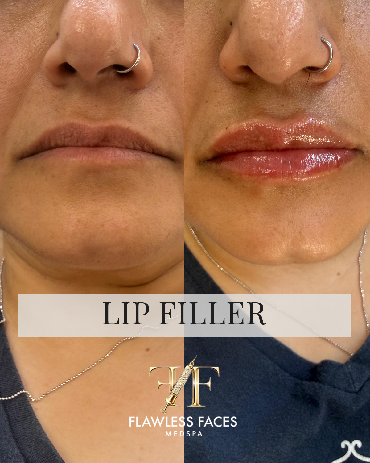 July lip filler 5